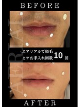 エアリアル 中津店/ヒゲ脱毛早くすればよかった！