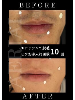 エアリアル 中津店/ヒゲ脱毛早くすればよかった!