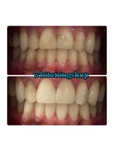 ホワイトニングショップ 大阪玉造店/Before&After美白ホワイトニング