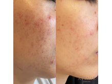 アベニール 芦屋/生理前ニキビ/黒ずみケア