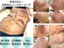 プリュボーテ(Pul Beaute)の雰囲気(最大約250万本の天然微細針がお肌を活性化!ハーブピーリング!)