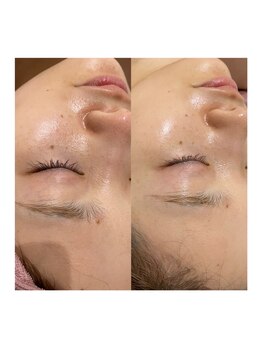 サロンドエデン 恵比寿店(Salon de Eden)/水光肌