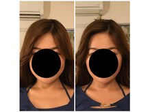 鍼灸サロン mの雰囲気（Before（左）→Ａfter（右）・M式小顔美顔コース　#美容鍼）