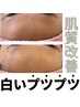 【肌質改善×ニキビケア】白いプツプツニキビケア専用