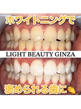 ライトビューティー 銀座店(LightBeauty)/東銀座　ホワイトニング症例写真