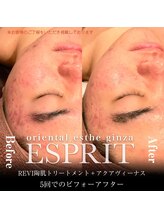 エスプリ 銀座店/ハーブピーリング銀座