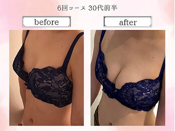 リール 恵比寿店(RIRE)/バストアップ症例【広尾恵比寿】