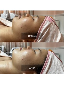 トータル フィルシャイン(Total Fillshine)/うるツヤ水光肌☆水素肌管理