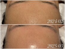 フォー(For...)/ツヤ肌◇ピーリングフェイシャル