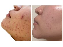 サプル(supple)の雰囲気（スタッフ自身も肌悩み多いです！一緒に美肌を目指しましょう！）