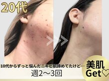 ヨサパーク ア モード ミオ 柴又店(YOSA PARK A modo mio)/長年の肌荒れも解決!美肌ゲット!