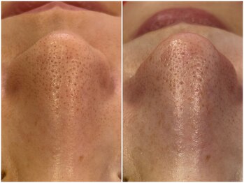 ファミーユ 太田(Fameu)/毛穴ピーリング　¥1100