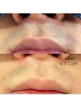 シャレールオム(Chareir Homme)/ヒゲ脱毛12回のビフォーアフター