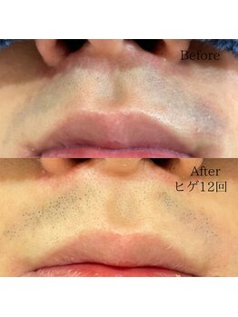 シャレールオム(Chareir Homme)/ヒゲ脱毛12回のビフォーアフター