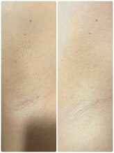 リノ(Lino)/脱毛ビフォアフ