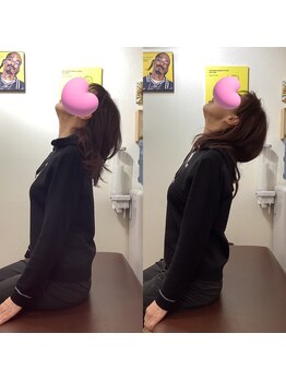 ヒデ整体院(Hide整体院)/猫背矯正骨盤矯正B/A肩こり腰痛