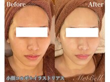 ミベル(MeBell)/小顔コルギ×イラストリアス