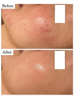 メロー(MELLOW)/ニキビ・赤み