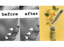 レンリー(Renry)の雰囲気（小顔＋毛穴ケア♪レモンボトル＋エステダーマで理想のお肌に◎）