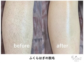 ヴィ オール(Vi.all)の写真/大宮で脱毛デビューしませんか？気になる脇やVIO、うなじへワックスと光のW脱毛をご提案！自信の持てる肌へ