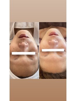 ディタ アンド ボーン(DITA&BORN)/フェイシャル事例