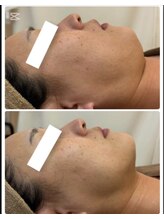 アンパス(Unpas)/透明美肌＋リンパ30分一度の結果