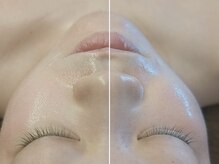 ワールドビューティー(World Beauty)/小顔×リフトアップフェイシャル