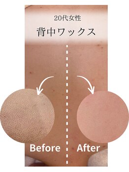 プアマヌ(PUA MANU)/背中wax光脱毛/ブライダル