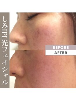 メロウ(mellow)/くすみにもIPL光フェイシャル☆