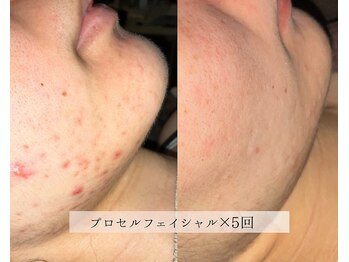 ル シーニュ/プロセルフェイシャル