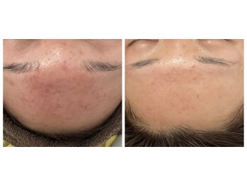 ヴィヴ コレビ(VIV COREBI)/ニキビケア