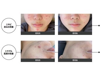 ユフラ(Juhla)/韓国式ハーブピーリング