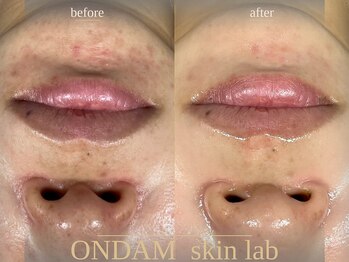 オンダム 表参道(ONDAM)/赤みニキビケアもお任せください
