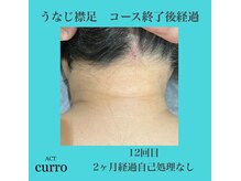 アクト クロ(ACT curro)/【うなじ襟足】脱毛施術例
