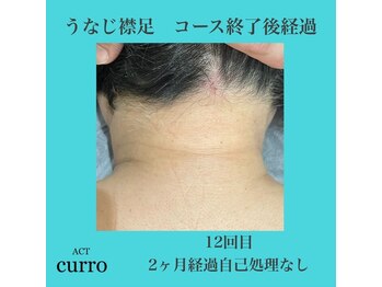 アクト クロ(ACT curro)/【うなじ襟足】脱毛施術例