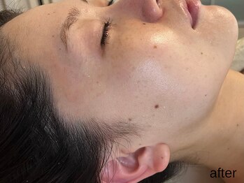 サロン ド エメ(salon de aimer)/【After】更に理想の輪郭へ♪