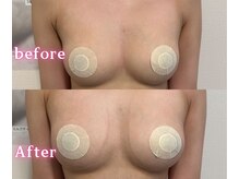 ジュエルリング(Jewel Ring)/症例写真バストアップ