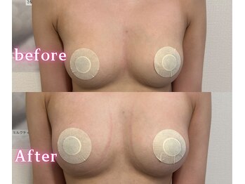 ジュエルリング(Jewel Ring)/症例写真バストアップ