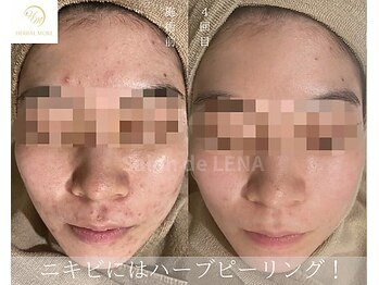 サロン ド レナ(Salon de LENA)/ハーブピーリング サロンドレナ