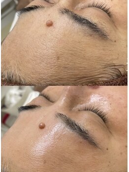 ボーテ(beaute)の写真/産毛/角質すっきり!全顔ワックス脱毛で叶えるつるすべ美肌♪保湿/鎮静/美肌パック付で透明感UP&化粧ノリ◎