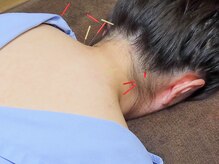 鍼灸整体院ワト 三軒茶屋院(鍼灸整体院WATO)/■首・肩の鍼灸施術例