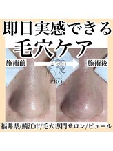 ピュール 鯖江店(PUR)/毛穴/毛穴ケア/毛穴洗浄