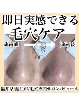 ピュール 鯖江店(PUR)/毛穴/毛穴ケア/毛穴洗浄