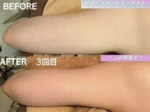 ラディアント(Radiant)/インディバ×レモンボトル