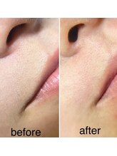 リュクスルーム(Luxe room)/30代：潤艶WAX脱毛１回　口元