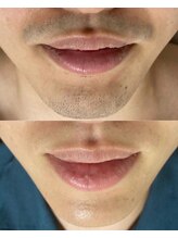 ジェムの森/ひげ脱毛 before after写真