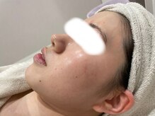 ビューティーサロン アンド ユー シブヤ(Beauty Salon&U Shibuya)/肌質改善施術前