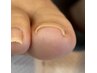 【爪のお悩みに】巻き爪1本+カウンセリング　