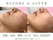 ロエヴェ(ROEWE)/ニキビ改善・毛穴ケア・肌質改善