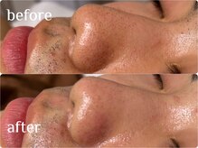 ワイスリー(Y3)/水素毛穴洗浄